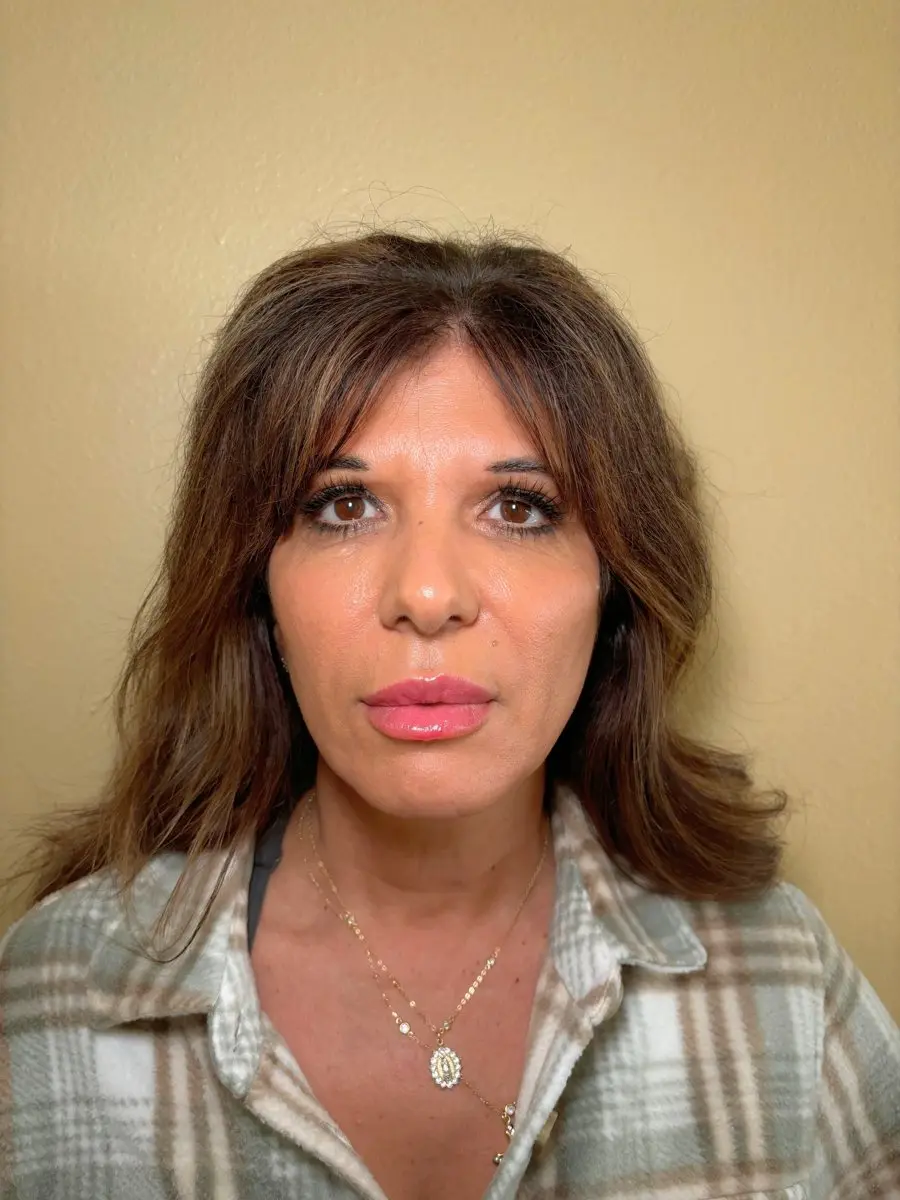 Face after Plexr Plus mole removal
